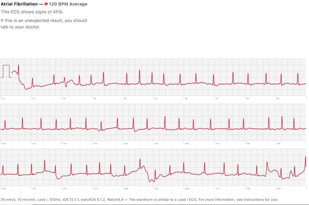 Apple Watch Series 4 ECG result