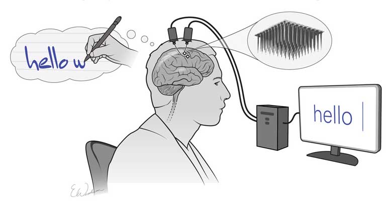 Neural implant allows paralyzed individual to type at the speed of an average smartphone user